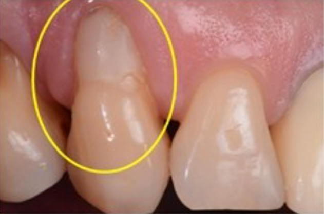 論壇探討「牙齦覆蓋術」：牙齒很白、很整齊，但牙齦就是不對勁！！是牙周病嗎？