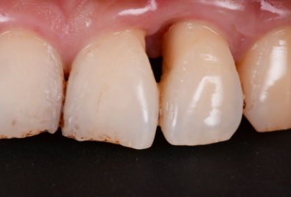 牙科三角關係-淺談牙齒間的黑三角縫隙