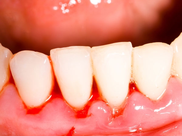 牙周病患者的牙齒矯正計畫！？