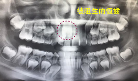 Read more about the article 孩子牙齒看似長歪了，該矯正嗎？兒童「早期矯正」是甚麼？