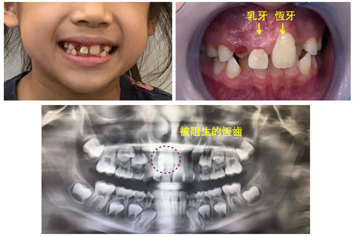 孩子牙齒看似長歪了，該矯正嗎？兒童「早期矯正」是甚麼？